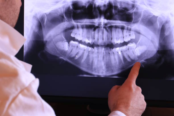 Best Emergency Treatment for Dental Infections or Abscesses in Bertsch Oceanview, CA